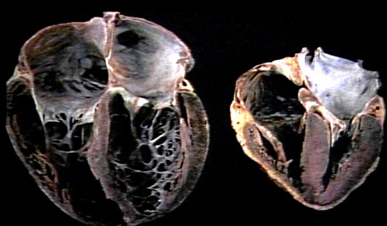 Chronic Ischemic Heart Disease Cardiovascular Medbullets Step 1